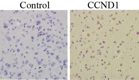 Immunohistochemistry (human glioma tissue), CCND1 antibody (A1301), 1:50 dilution, IHC Validated