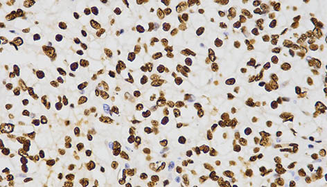 Immunohistochemistry (paraffin-embedded human liver cancer tissue), H3K27me2 antibody, dilution of 1:200 (x400 lens), ChIPseq Grade